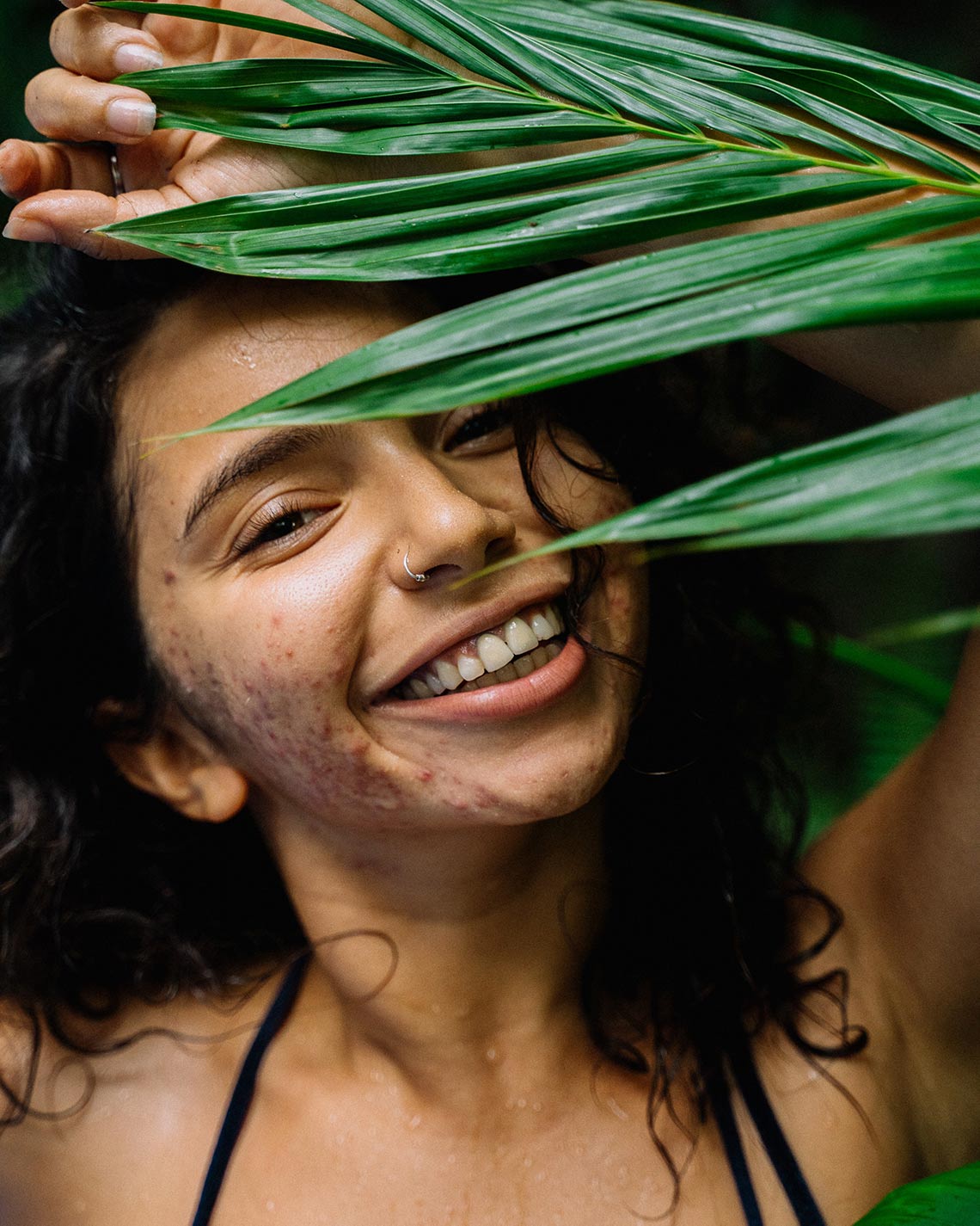 How to Get Rid of Acne Scars