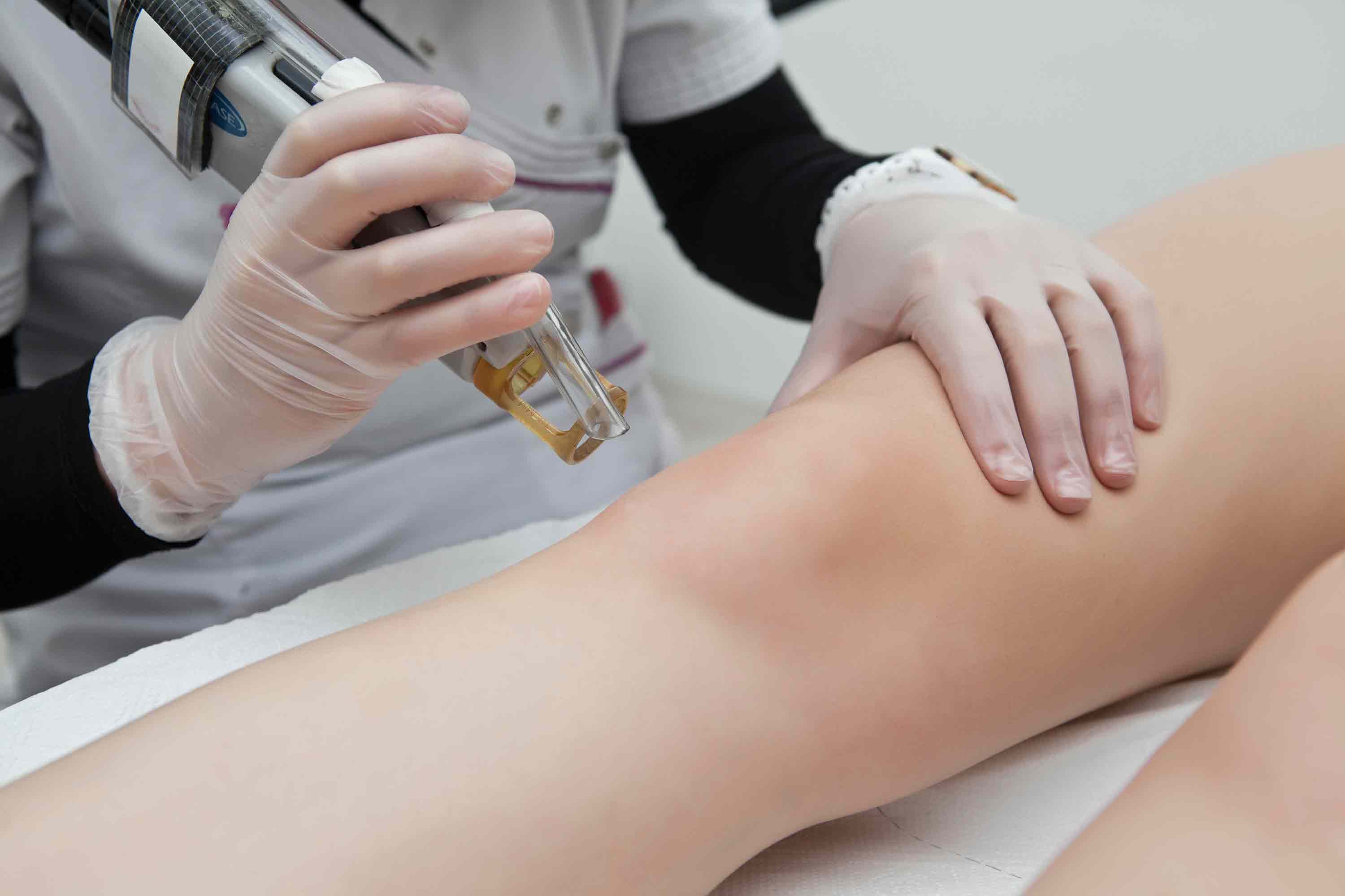 Everything You Need To Know About Laser Hair Removal